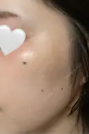 ほくろ・いぼ除去レーザー（肌） / シミ取りレーザー eクリニック 金沢本院 DAY 12 サムネイル用