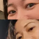 下まぶたの脂肪取り 品川美容外科 渋谷院（※品川スキンクリニック提携） DAY 18 サムネイル用