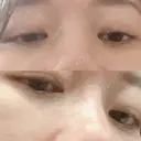 下まぶたの脂肪取り 品川美容外科 渋谷院（※品川スキンクリニック提携） DAY 23 サムネイル用