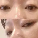 下まぶたの脂肪取り 品川美容外科 渋谷院（※品川スキンクリニック提携） DAY 24 サムネイル用