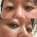 下まぶたの脂肪取り 品川美容外科 渋谷院（※品川スキンクリニック提携） DAY 25 サムネイル用
