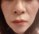 脂肪溶解注射（顔） 目白ホワイトクリニック DAY 30 サムネイル用