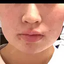 ボトックス（エラ・小顔） BiBiクリニック AFTER サムネイル用