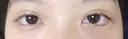 二重埋没 / 目尻切開 / タレ目形成・グラマラスライン（埋没） LOUIS CLINIC 二子玉川院【ルイクリニック】 DAY 1 サムネイル用