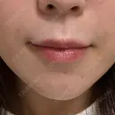 肌ヒアルロン酸注入（たるみ・シワ改善） KIMI CLINIC 形成・美容外科 AFTER サムネイル用