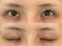 二重切開 / 眼瞼下垂（切開） / スレッドノーズ / ヒアルロン酸注入（鼻翼基部） オーキッド美容クリニック東京御徒町 DAY 240 サムネイル用