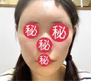 額を丸く / 脂肪注入（肌） / 脂肪注入（額） 湘南美容クリニック 柏院 DAY 61 サムネイル用