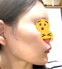 額を丸く / 脂肪注入（肌） / 脂肪注入（額） 湘南美容クリニック 柏院 DAY 61 サムネイル用