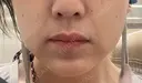 ボトックス（あご） / ボトックス（エラ・小顔） / 脂肪溶解注射（顔） / ボトックス（人中） Kinshicho Beauty Clinic （錦糸町ビューティークリニック） DAY 6 サムネイル用
