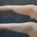 脂肪吸引（顔） / 脂肪吸引（二の腕） / 脂肪吸引（脚） / 脂肪吸引（お腹） / 脂肪吸引（お尻） / 脂肪吸引（腰） / 脂肪吸引（背中） / 脂肪吸引（肩） ヴェルトラクリニック 新宿院 AFTER サムネイル用