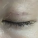 眼瞼下垂（非切開） SOL CLINIC DAY 8 サムネイル用