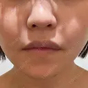 鼻翼基部形成（貴族手術） / ヒアルロン酸注入（鼻） / ボトックス（口角） / ボトックス（人中） eクリニック 名古屋院 DAY 9 サムネイル用