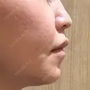 鼻翼基部形成（貴族手術） / ヒアルロン酸注入（鼻） / ボトックス（口角） / ボトックス（人中） eクリニック 名古屋院 DAY 9 サムネイル用