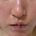 ポテンツァ ルラ美容クリニック 岡山院 DAY 0 サムネイル用