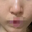 ポテンツァ ルラ美容クリニック 岡山院 DAY 1 サムネイル用