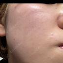 ピーリング（ハリ・ツヤ） / ルメッカ PureMe Skin Clinic（ピュアミースキンクリニック麻布） DAY 0 サムネイル用