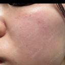 ピーリング（ハリ・ツヤ） / ルメッカ PureMe Skin Clinic（ピュアミースキンクリニック麻布） DAY 0 サムネイル用