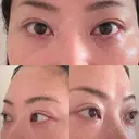 クマ治療 EMMO FACE CLINIC 東京三田院 AFTER サムネイル用