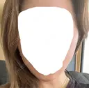 糸リフト Stand by Beauty Clinic AFTER サムネイル用