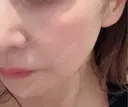肌ヒアルロン酸注入（たるみ・シワ改善） DMTC美容皮膚科 大宮院 AFTER サムネイル用