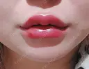 ボトックス（エラ・小顔） / ヒアルロン酸注入（唇） / ボトックス（首） ROHE CLINIC GINZA DAY 0 サムネイル用
