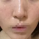 ポテンツァ ルラ美容クリニック 岡山院 DAY 2 サムネイル用