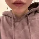 ヒアルロン酸注入（涙袋） / 脂肪溶解注射（顔） 麻布十番クレールデンタルクリニック AFTER サムネイル用