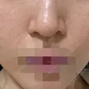 ポテンツァ ルラ美容クリニック 岡山院 DAY 3 サムネイル用