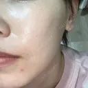 ピーリング（ニキビ・毛穴） / 光治療（フォトフェイシャルなど） RAISE CLINIC 【レイズクリニック】 DAY 0 サムネイル用