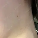 その他（鼻） / ボトックス（エラ・小顔） / ボトックス（口角） eクリニック 福岡院 DAY 0 サムネイル用