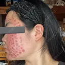 美肌レーザー / 赤み除去レーザー / ニキビ治療 医療法人河田外科形成外科 DAY 0 サムネイル用