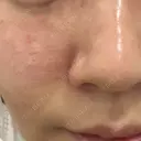 肌育注射（ジュベルックなど） 城本クリニック 長野院 AFTER サムネイル用