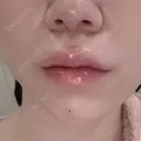 ヒアルロン酸注入（あご） / ヒアルロン酸注入（唇） / ボトックス（口角） ルラ美容クリニック 大阪本院 DAY 0 サムネイル用