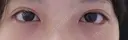 二重埋没 / 目尻切開 / タレ目形成・グラマラスライン（埋没） LOUIS CLINIC 二子玉川院【ルイクリニック】 DAY 6 サムネイル用