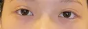 二重埋没 / 目尻切開 / タレ目形成・グラマラスライン（埋没） LOUIS CLINIC 二子玉川院【ルイクリニック】 AFTER サムネイル用