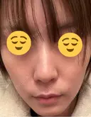 医療脱毛（顔） ZX-CLINIC 梅田院 AFTER サムネイル用