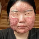 美肌レーザー / 赤み除去レーザー / ニキビ治療 医療法人河田外科形成外科 DAY 1 サムネイル用