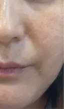 ピコレーザートーニング（美白・かんぱん） / ピコフラクショナルレーザー（毛穴・ニキビ跡） 大美会クリニック 天王寺院 DAY 4 サムネイル用