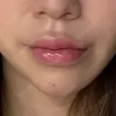 ヒアルロン酸注入（あご） / ヒアルロン酸注入（唇） / ボトックス（口角） ルラ美容クリニック 大阪本院 AFTER サムネイル用