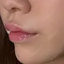 ヒアルロン酸注入（あご） / ヒアルロン酸注入（唇） / ボトックス（口角） ルラ美容クリニック 大阪本院 DAY 3 サムネイル用