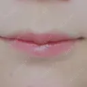 ヒアルロン酸注入（唇） フィラークリニック 大阪梅田院 DAY 3 サムネイル用