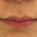 ヒアルロン酸注入（唇） フィラークリニック 大阪梅田院 DAY 4 サムネイル用
