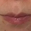 ヒアルロン酸注入（唇） フィラークリニック 大阪梅田院 DAY 5 サムネイル用