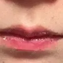 ヒアルロン酸注入（唇） フィラークリニック 大阪梅田院 DAY 6 サムネイル用