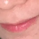 ヒアルロン酸注入（唇） フィラークリニック 大阪梅田院 DAY 8 サムネイル用