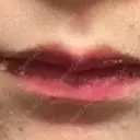 ヒアルロン酸注入（唇） フィラークリニック 大阪梅田院 DAY 8 サムネイル用