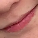 ヒアルロン酸注入（唇） フィラークリニック 大阪梅田院 DAY 9 サムネイル用
