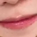 ヒアルロン酸注入（唇） フィラークリニック 大阪梅田院 AFTER サムネイル用