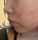 ヒアルロン酸注入（あご） / ヒアルロン酸注入（鼻翼基部） / RF（高周波）たるみ治療 gift clinic DAY 1 サムネイル用