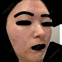 ニードルRF（ポテンツァなど） GRACY TOKYO CLINIC【グレイシートウキョウクリニック】 DAY 0 サムネイル用